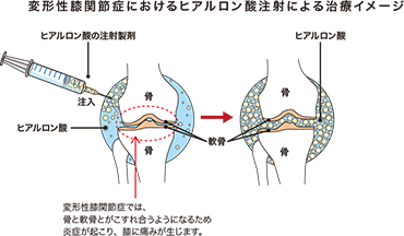 膝半月板損傷の治療ヒアルロン酸注射イラスト