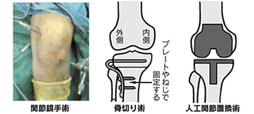 膝半月板損傷の人工膝関節置換術など手術写真・イラスト